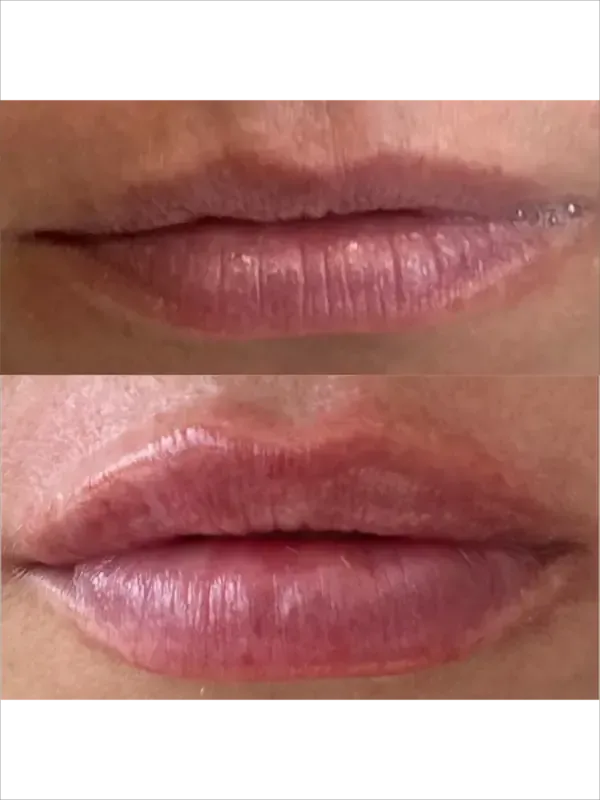 Close-up of lips, with the lower image showing swollen, red, and irritated lips.