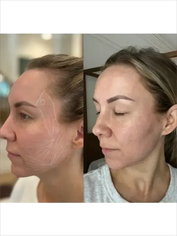 Side-by-side facial profile photos showing skin markings before and after treatment
