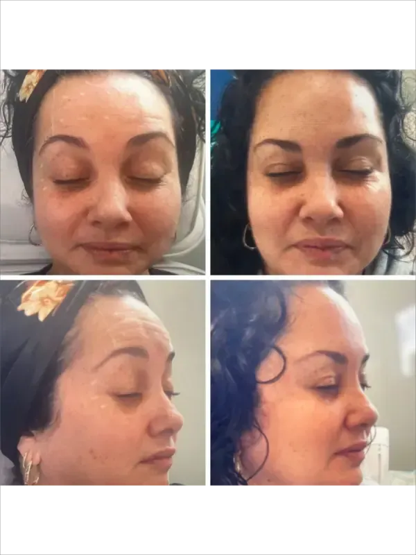 Four-panel close-up of a woman’s face from front and side, eyes closed, before-and-after skin treatment.