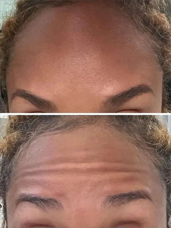 Close-up comparison of forehead wrinkles before and after skin smoothing, split horizontally