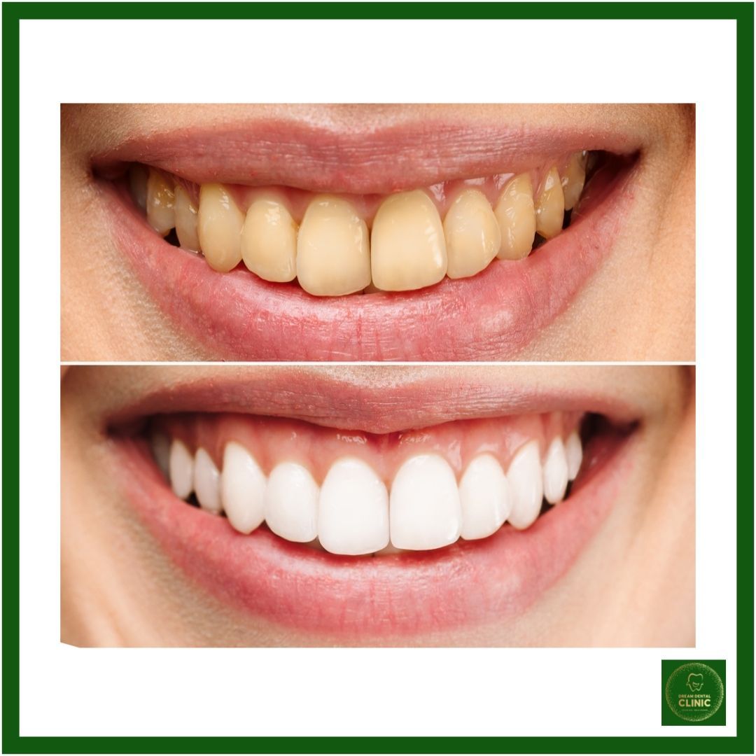 Teeth whitening