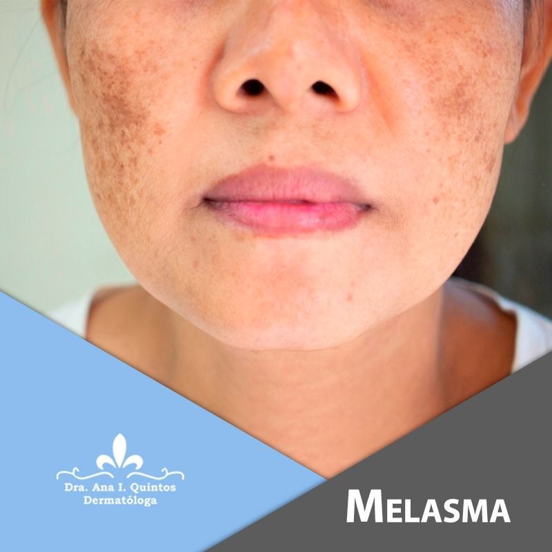 Dra. Ana Quintos - DERMATOLOGA