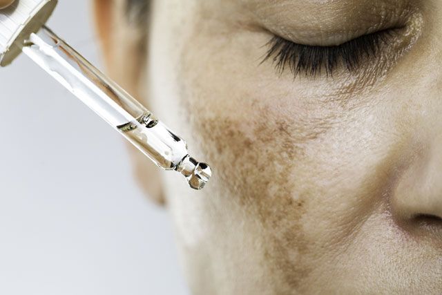 MELASMA