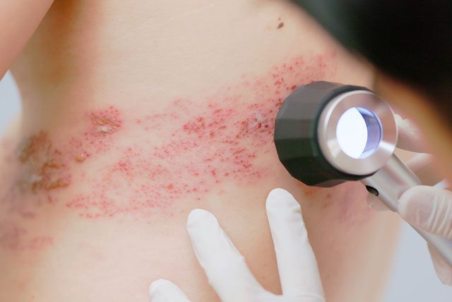 INFECCIONES CUTANEAS