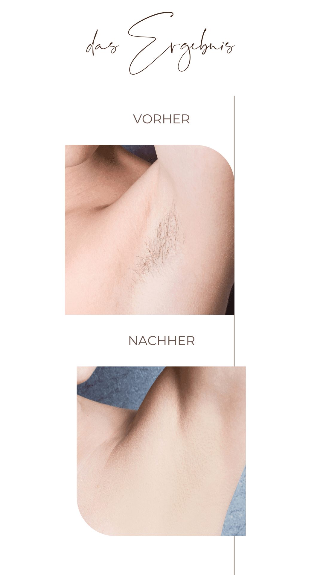 Ein Vorher-Nachher-Bild der Achselhöhle einer Frau.