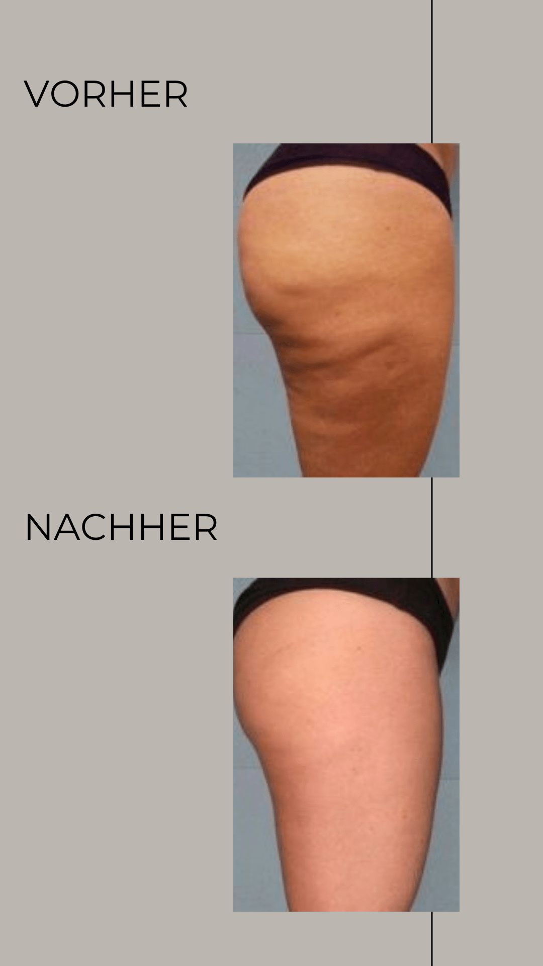 icoone laser
