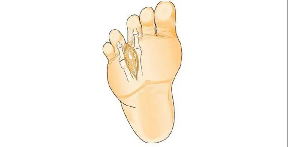 Neuroma i Mortonit