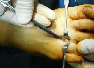 Neuroma i Mortonit