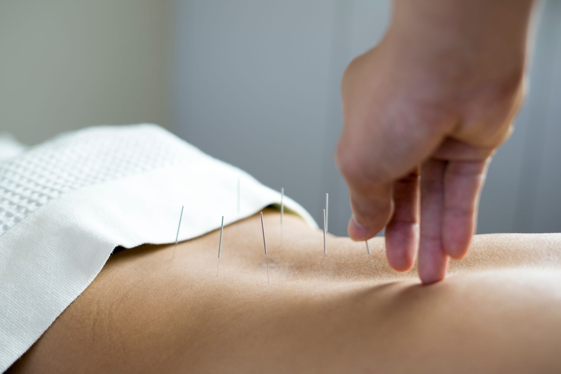 acupuncture needles being placed in a womans back
