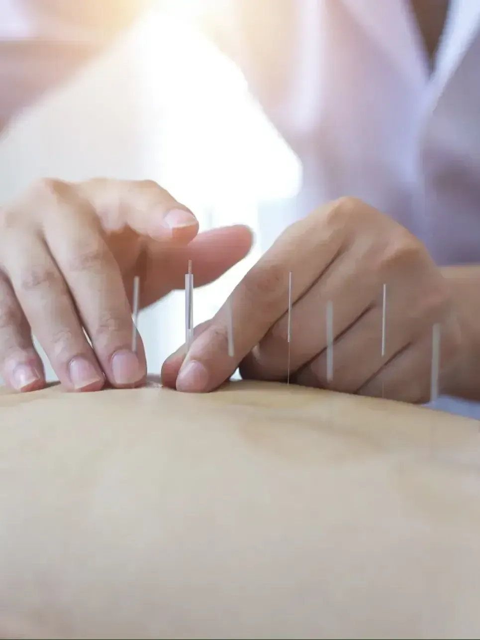 acupuncture needles
