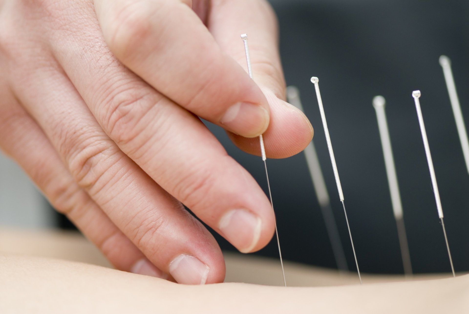Acupuncture Treatments | Evansville, IN | Winiger Chiropractic