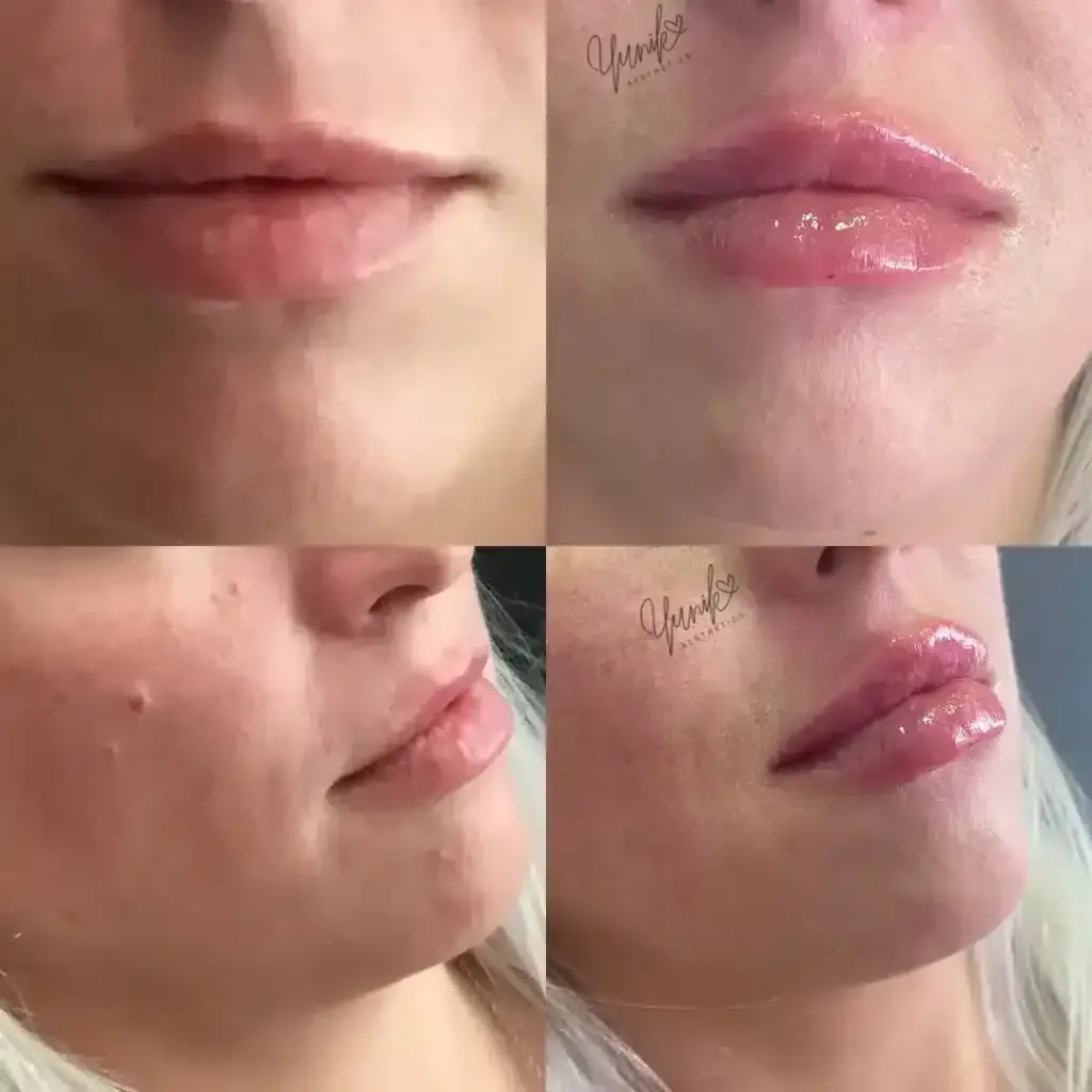 A Collage of Four Photos of A Woman 's Lips Before and After Lip Injections.