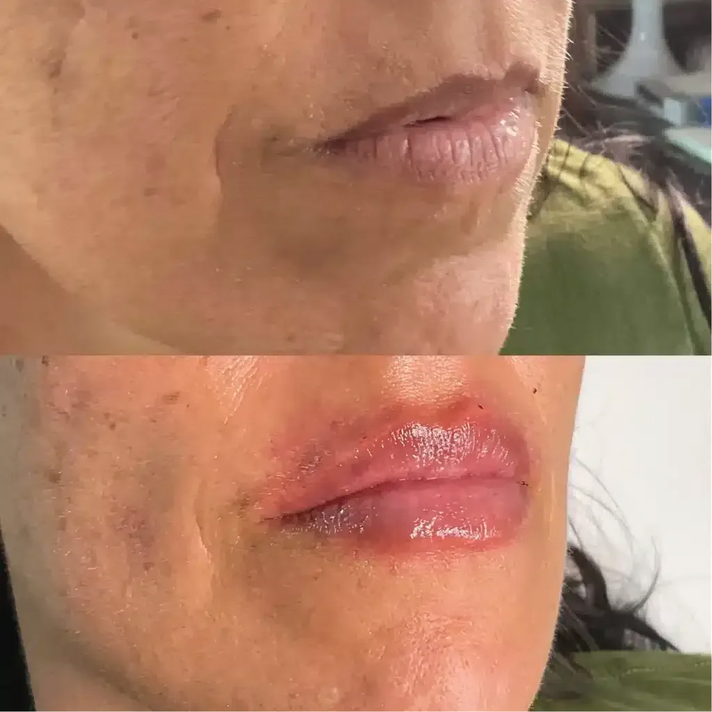 Lip Augmentation