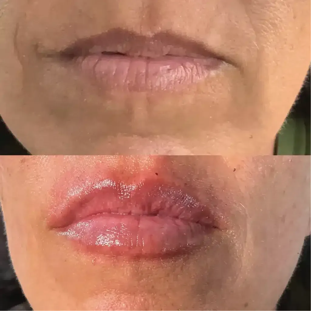 Lip Plastic Surgery