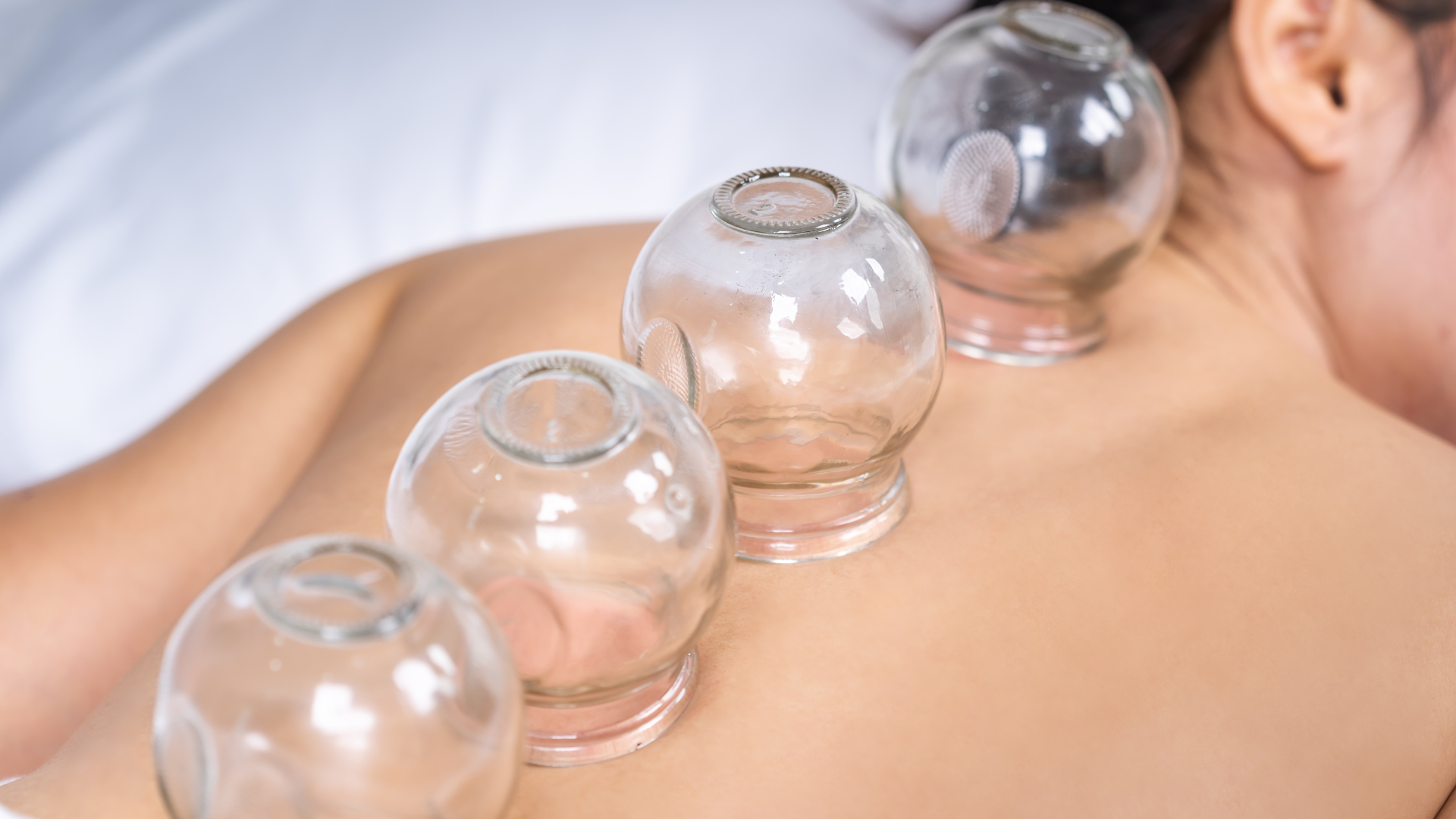 Cups on a person's back; a form of alternative medicine. Clear glass cups create a vacuum on the skin.