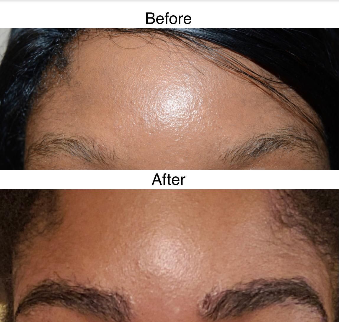 Eyebrow Hair Transplants Hair Transplant Manchester