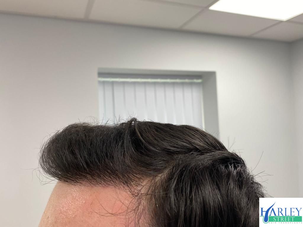 Hair Transplant Manchester Harley Street Manchester