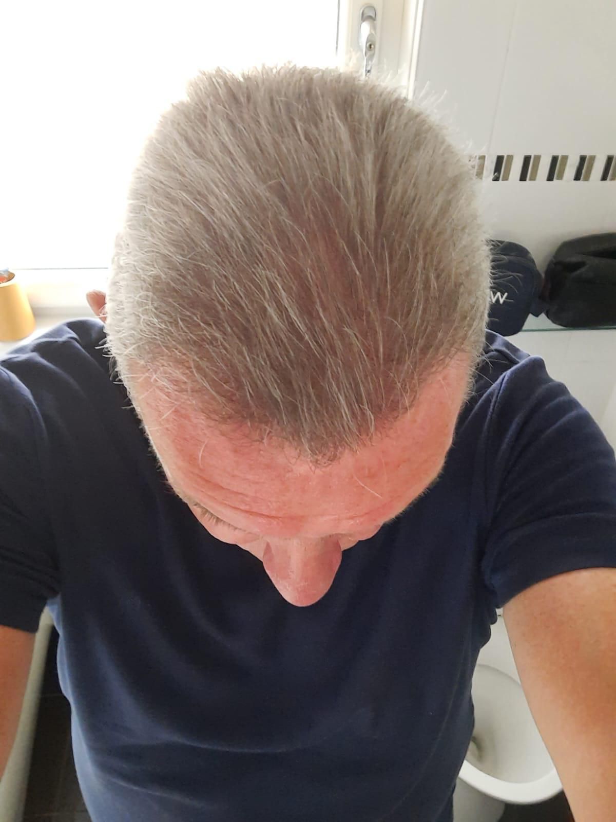 A picture of a hair transplant carried our by harley street hair transplants Manchester
