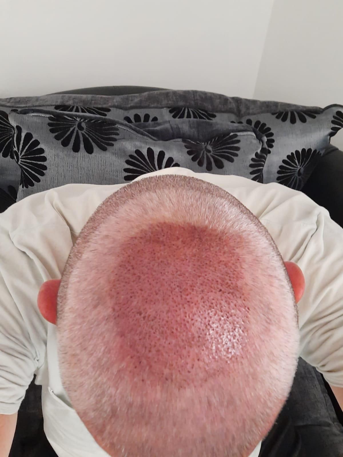 A picture of a hair transplant Manchester patient showing signs of male pattern baldness on the crown