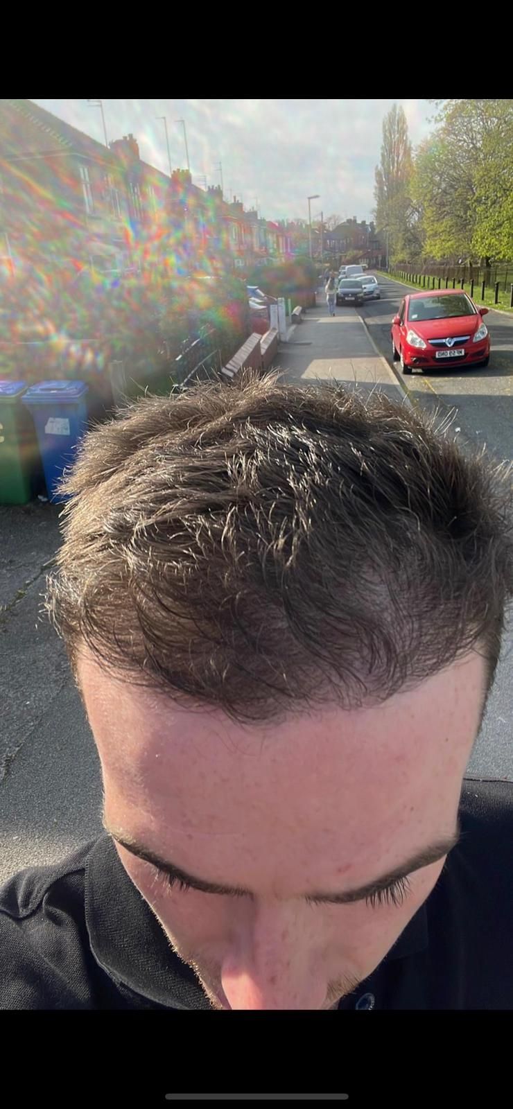 A picture of a FUE hair transplant carried out by Harley Street hair transplant Manchester