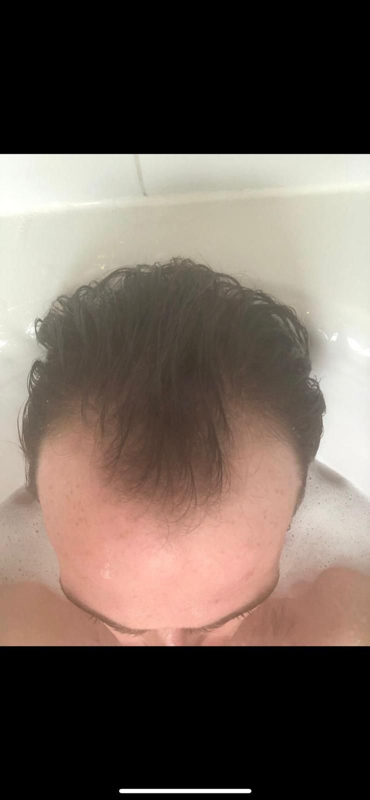 A picture of a hair transplant Manchester patient showing signs of male pattern baldness