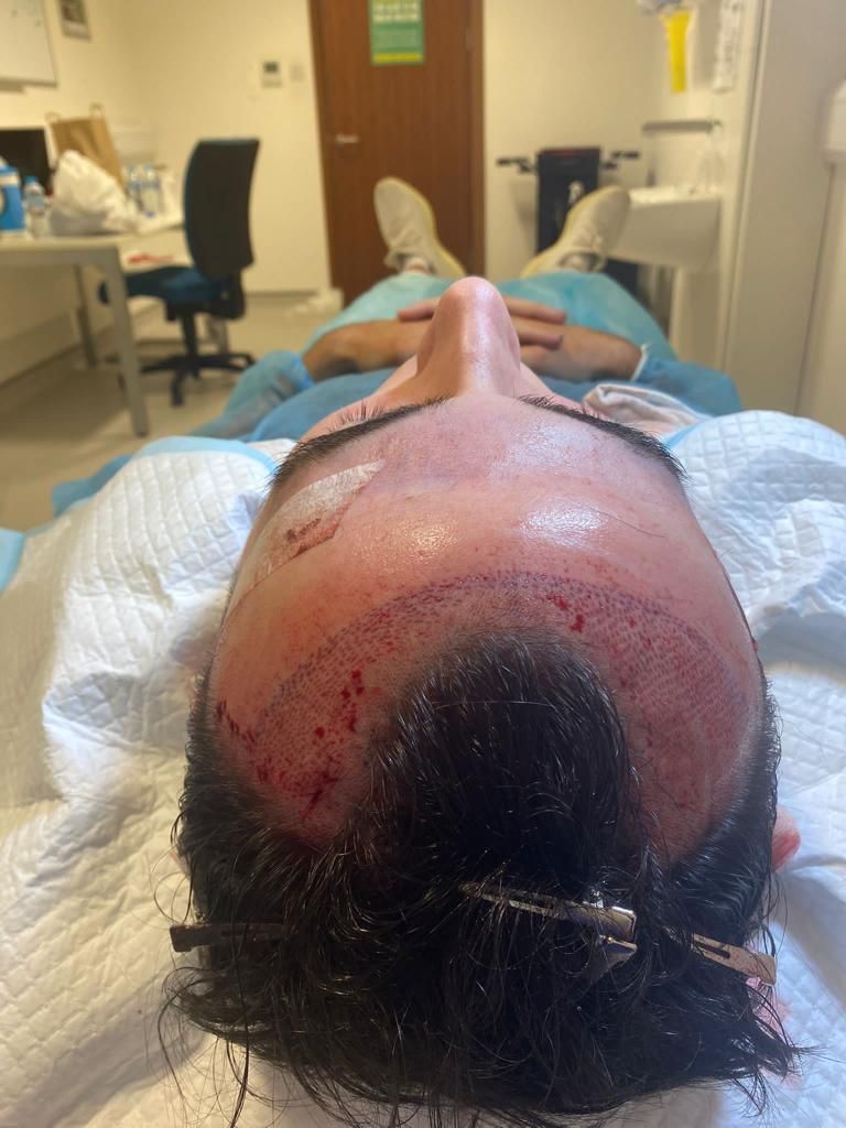 a picture of a male patient undergoing FUE at the manchester hair transplant clinic