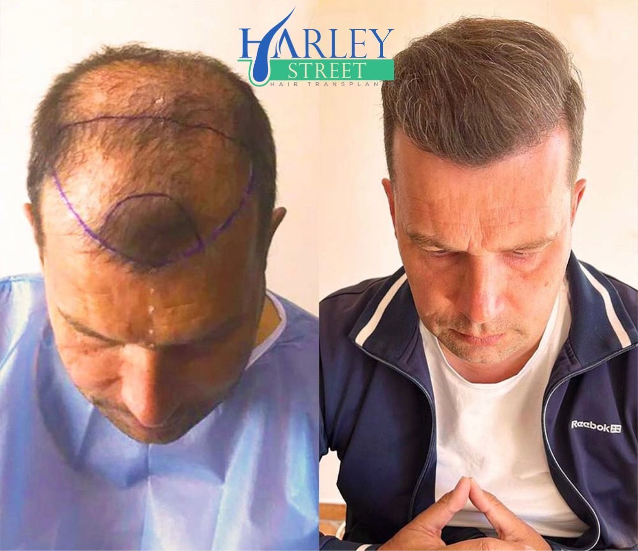 A male undergoing a FUE hair transplant.
before and after hair transplant