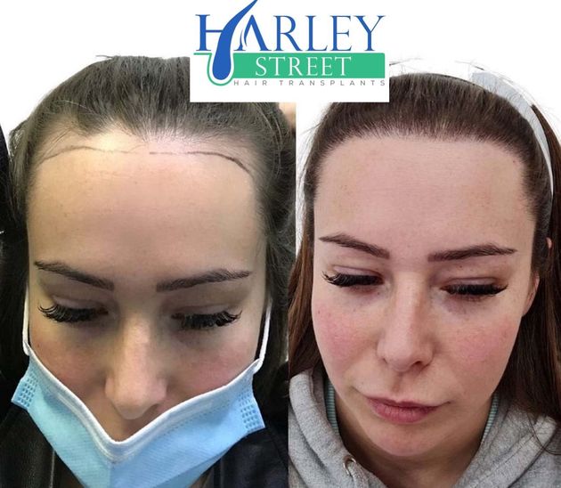 female hairline FUE hair transplant