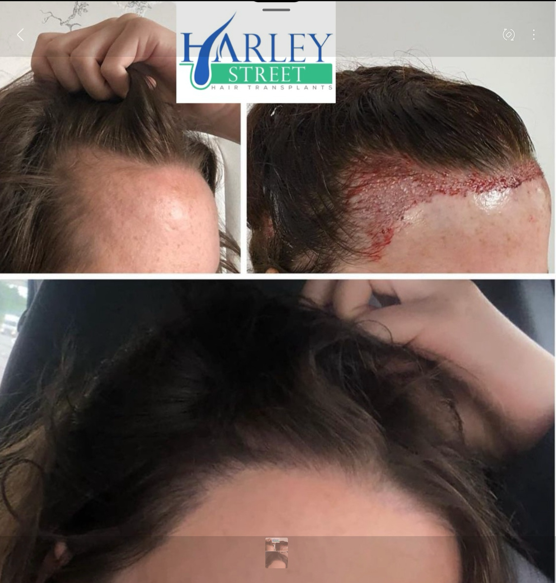 An after photo of a female who has undergone FUE surgery