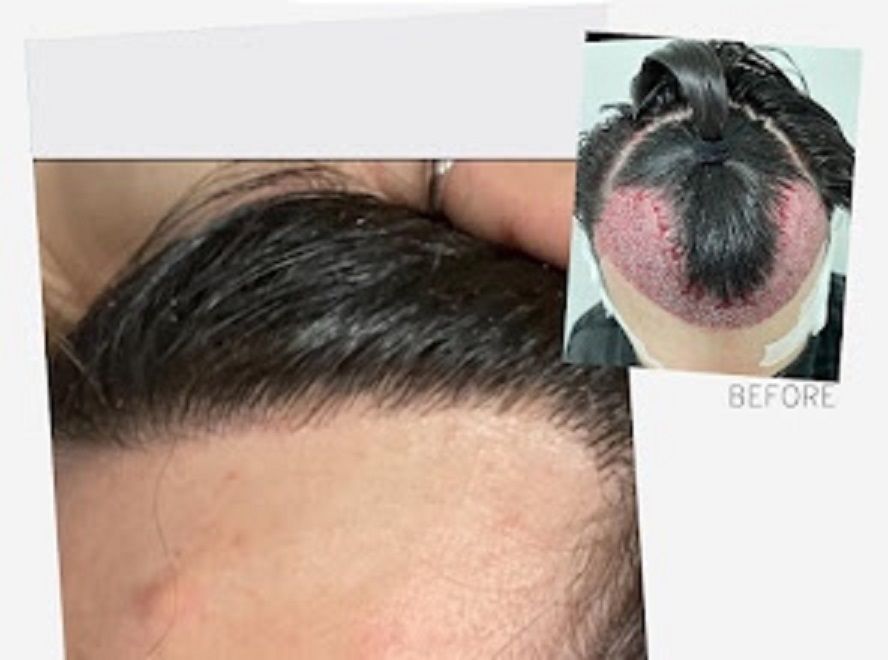 Before and after photos from a male who has undergone DHI treatment