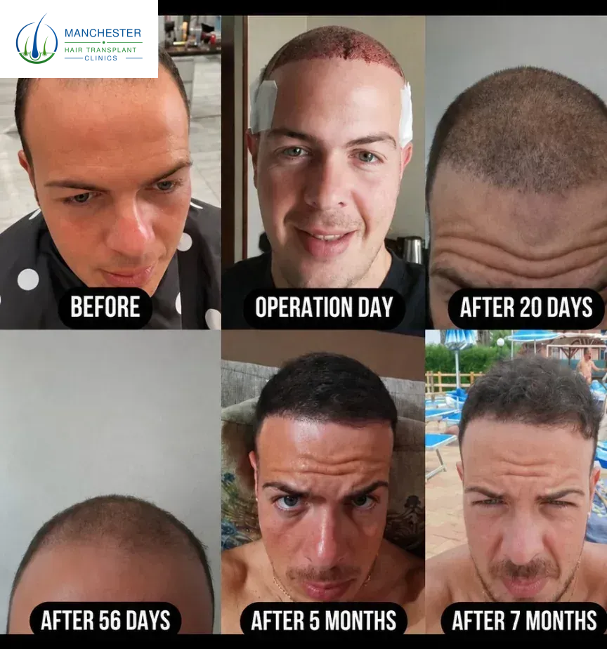 Hair transplant before and after result