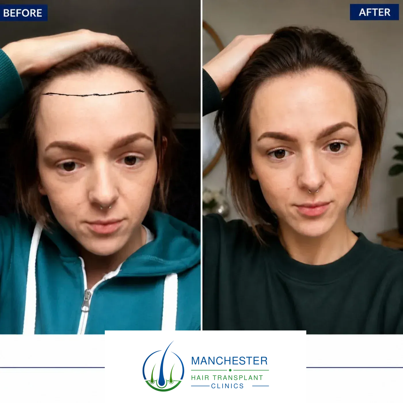 Female hairline restoration result