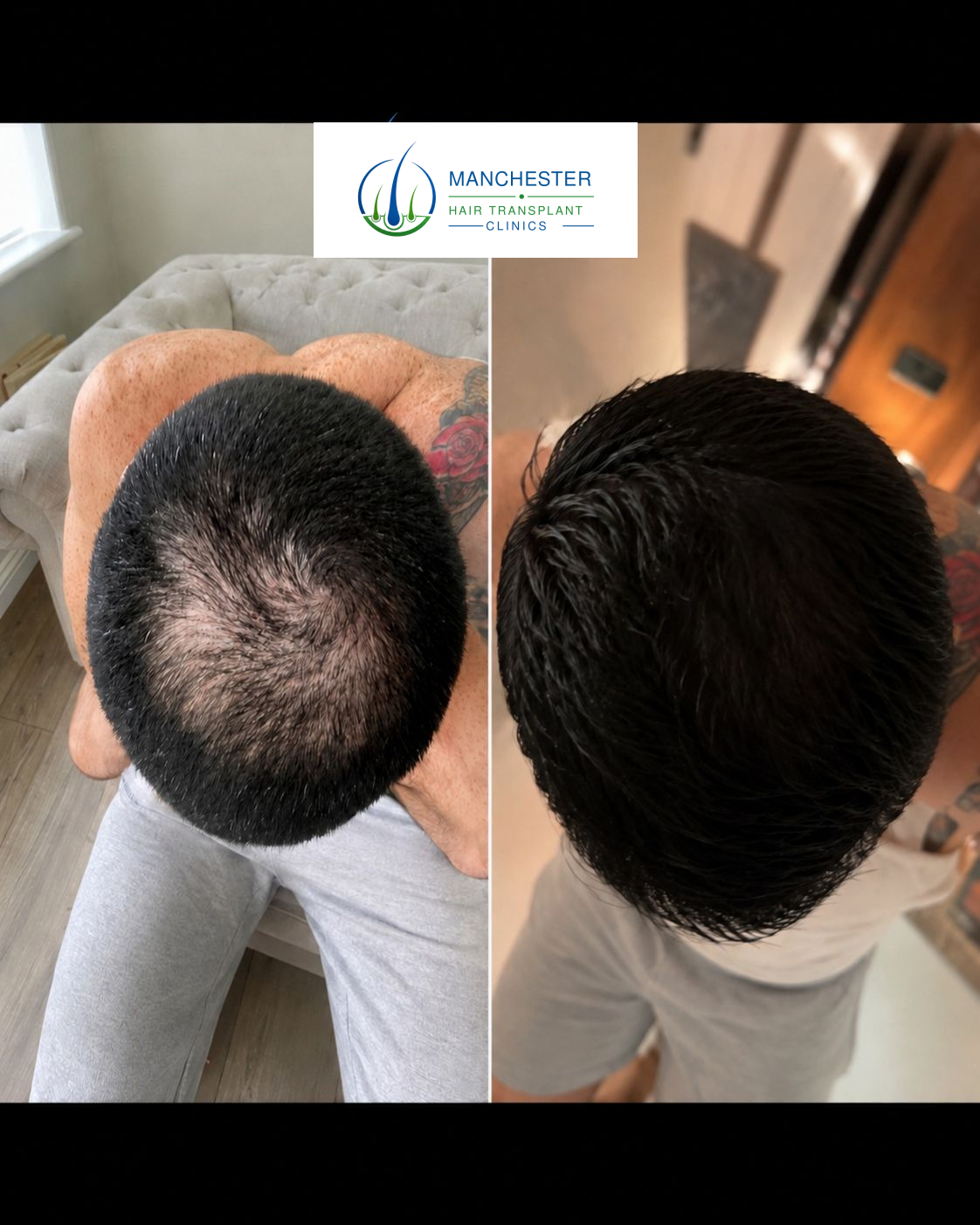 Hair-restoration treatment result