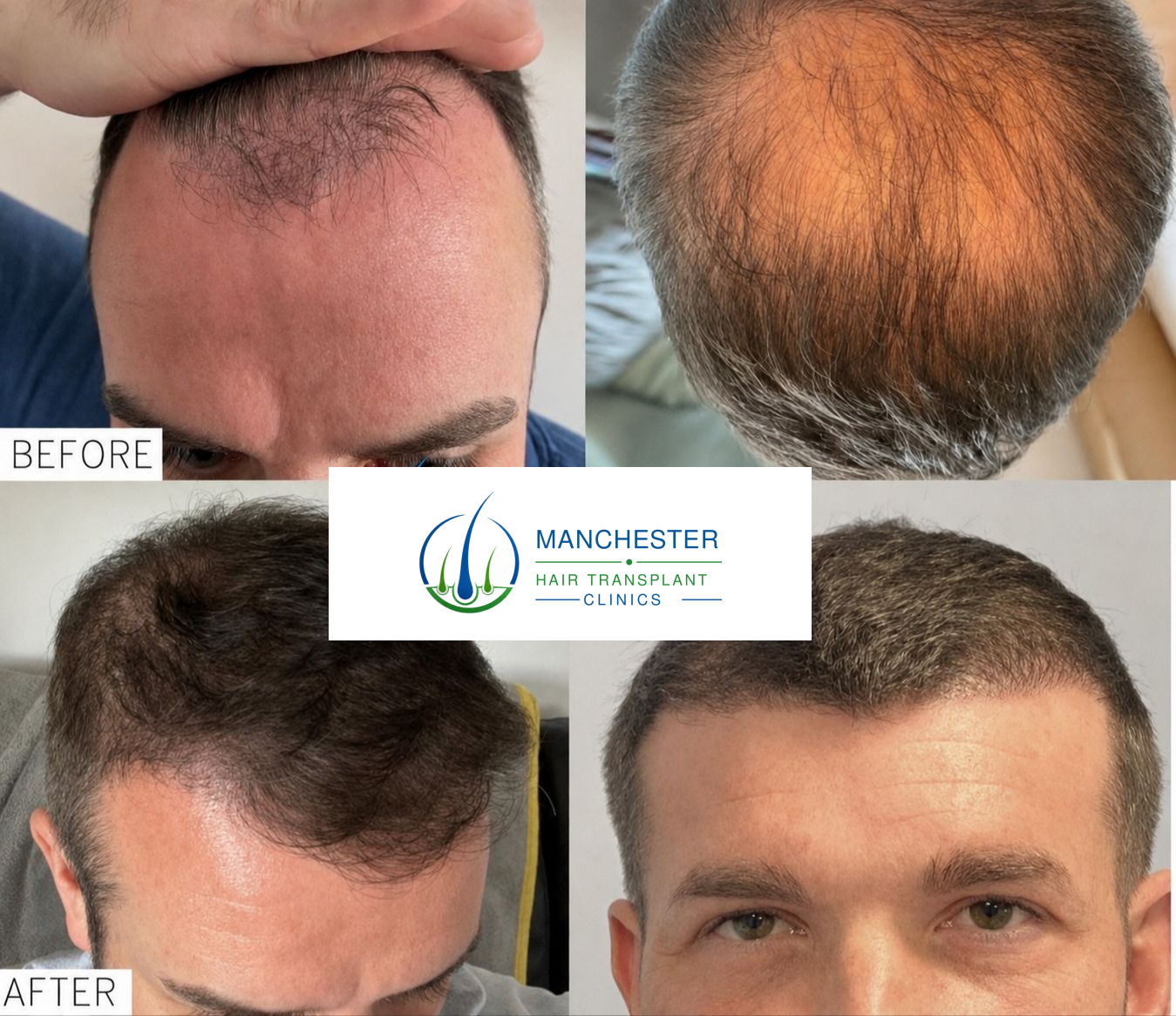 Hair transplant before and after patient result
