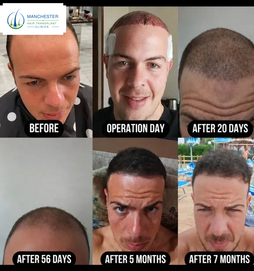 Hair transplant before and after result