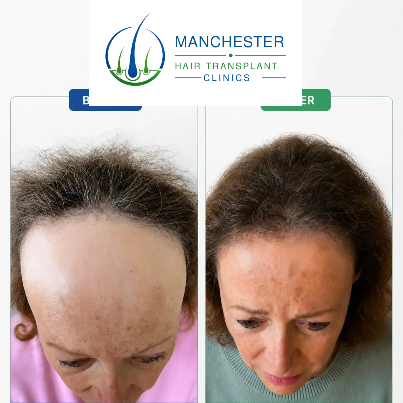 Female hair transplant before and after result