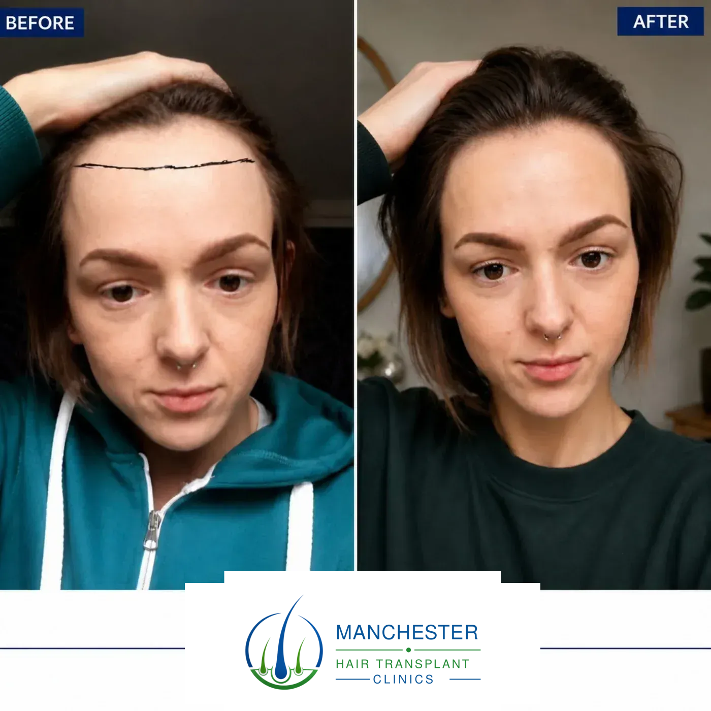 Female hairline restoration result