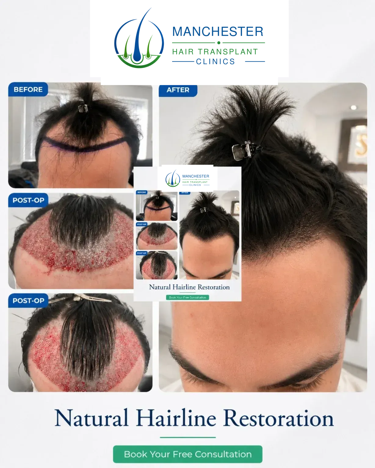Hairline transplant before and after result
