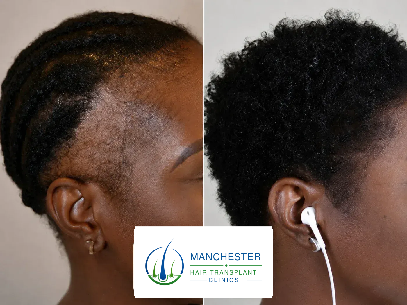 Hair-restoration before and after result