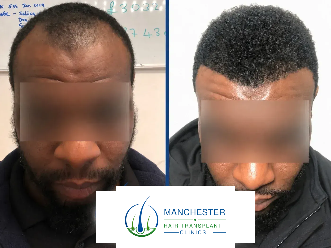 Afro hair transplant before and after result