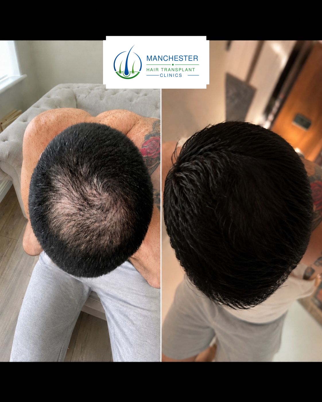 Hair-restoration treatment result