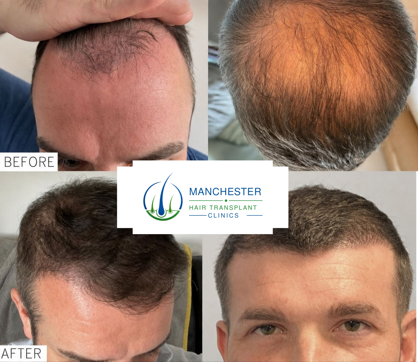 Hair transplant before and after patient result