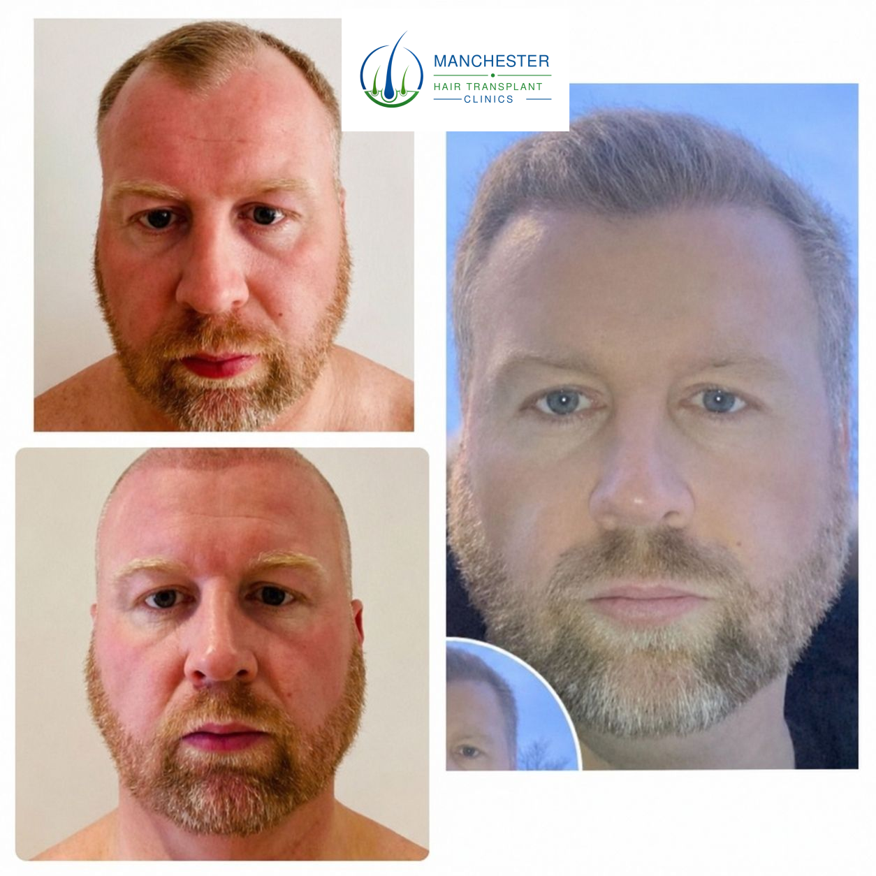 Hair transplant patient result