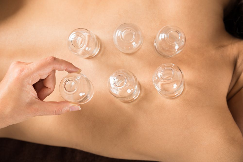 Person's Back With Six Glass Cups Applied — Leela Thai Massage & Spa in Newtown, QLD