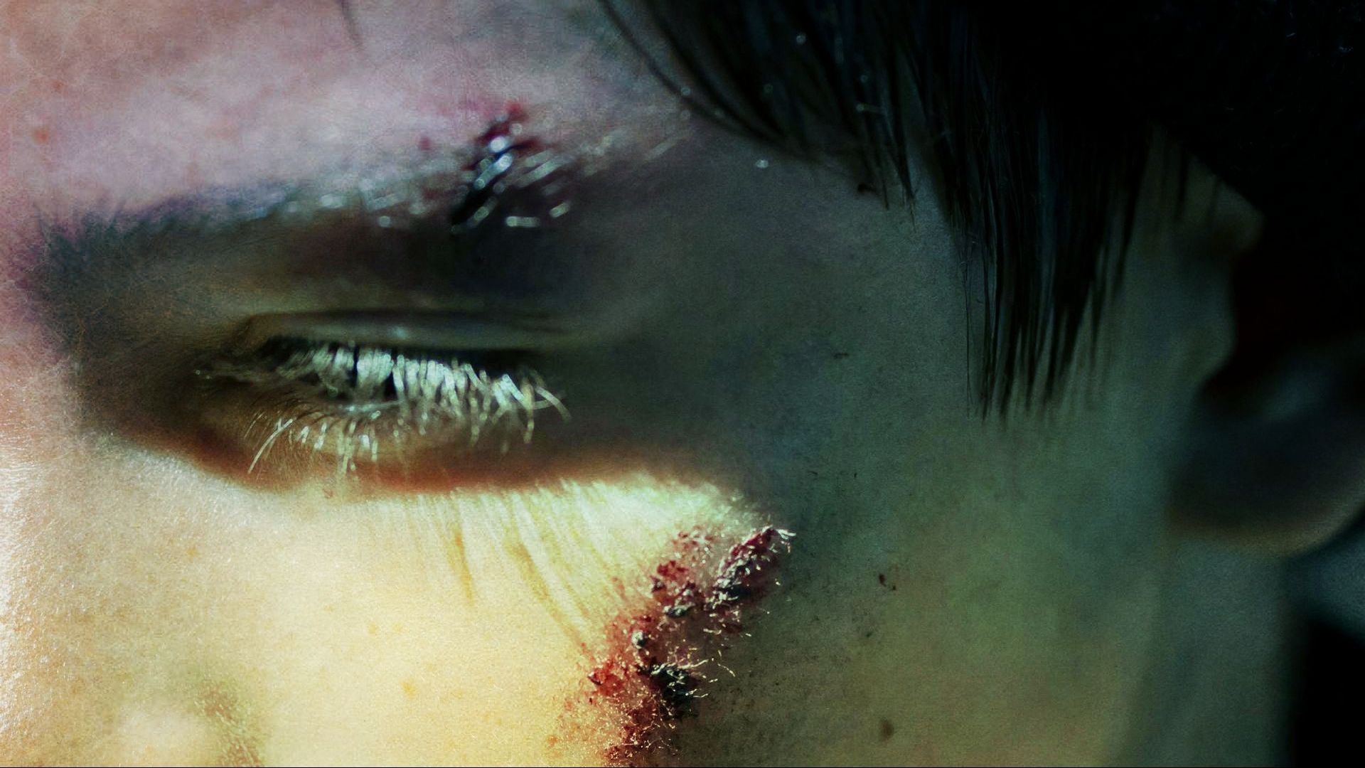 Close-up of a person's eye with visible cuts and abrasions near the eye and cheek.