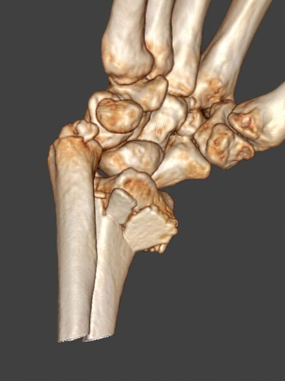 Pre-operative wrist image 5