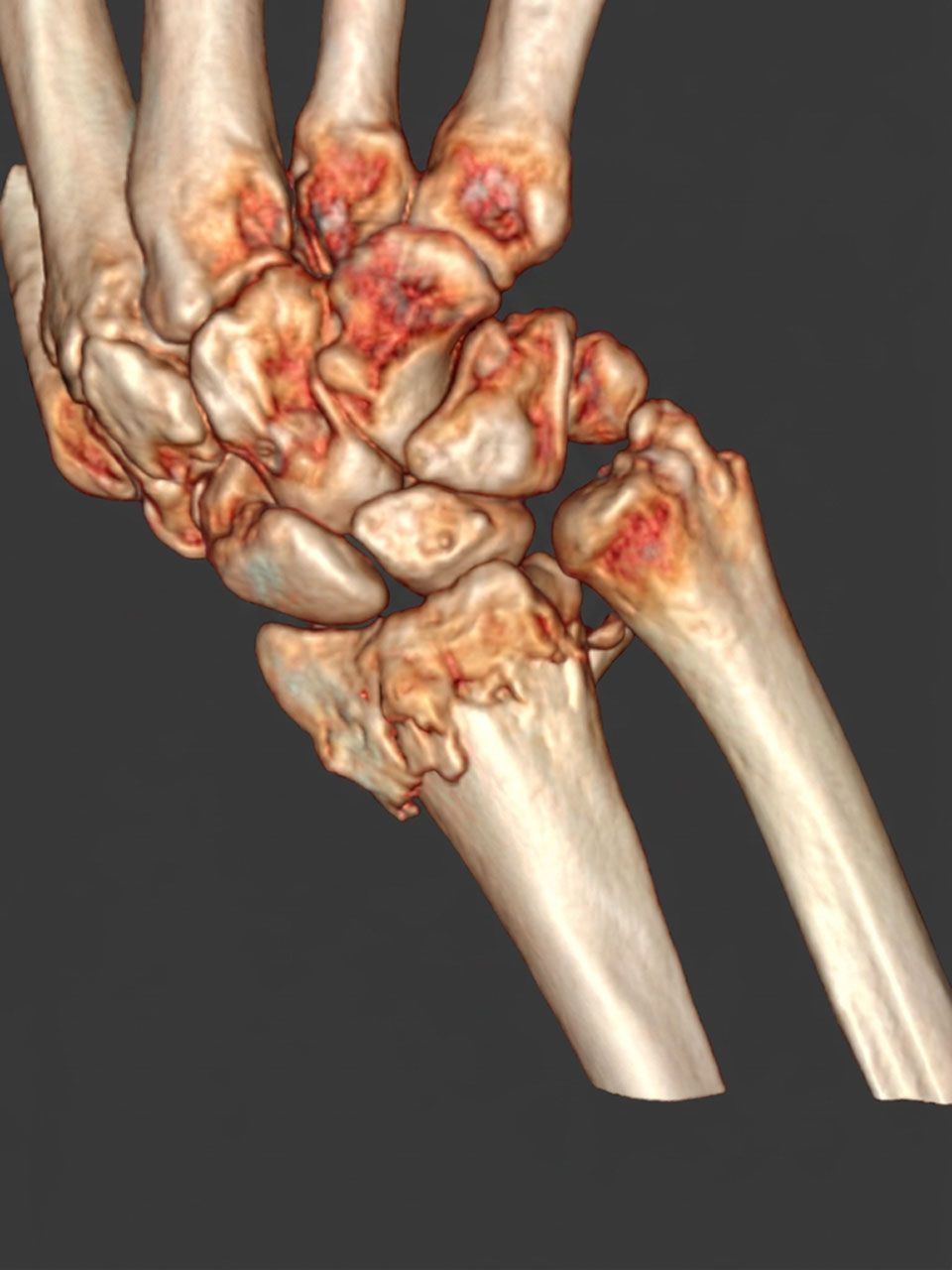 Pre-operative wrist image 4