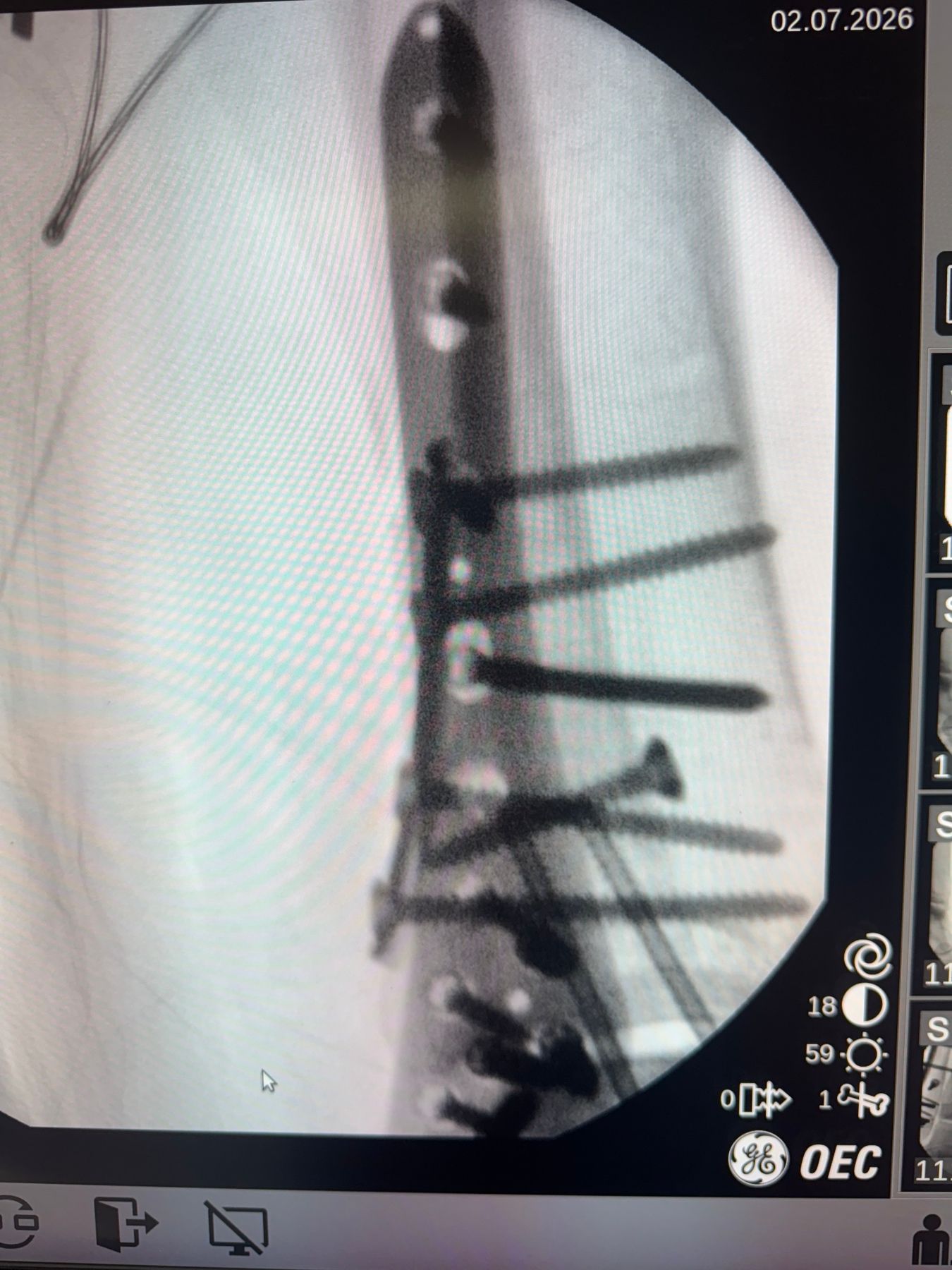 Post-operative image 1