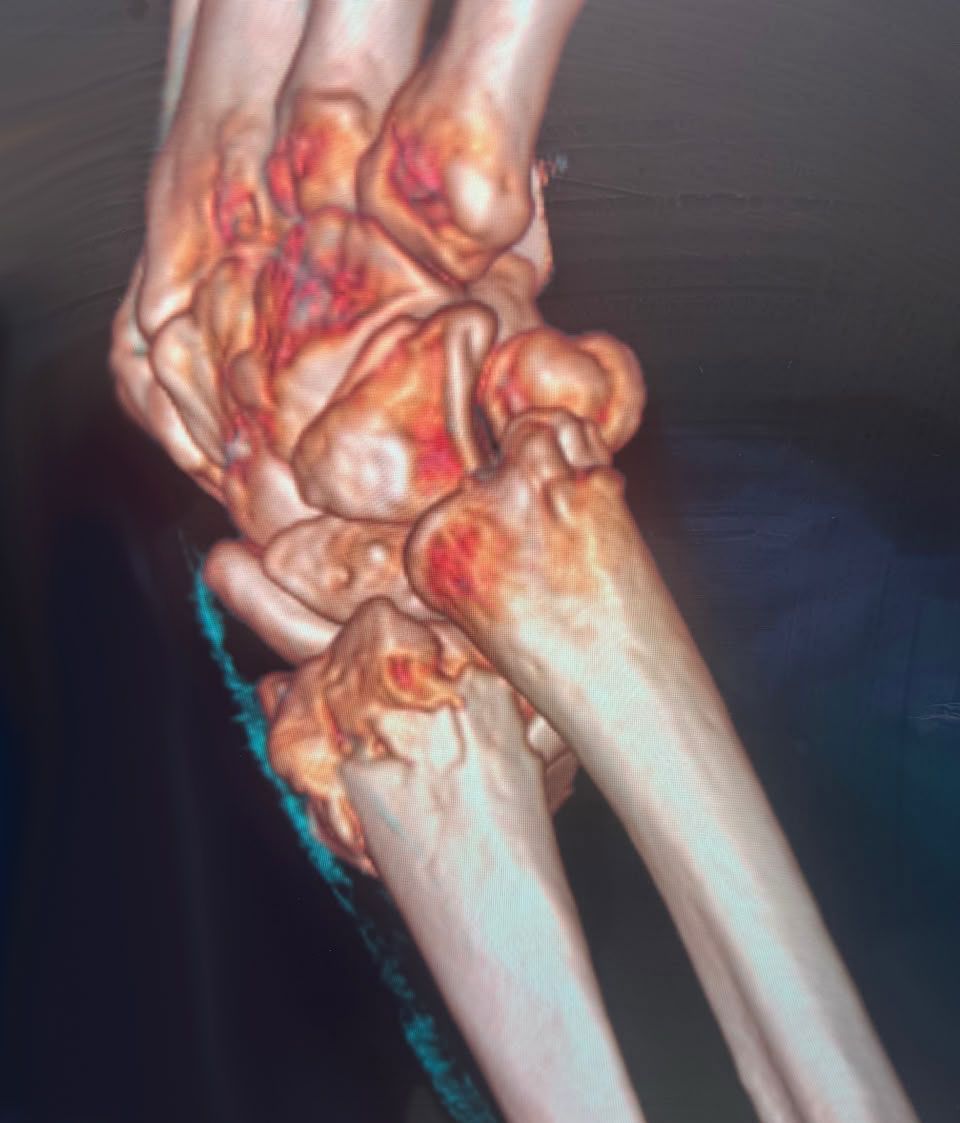 Pre-operative wrist image 3