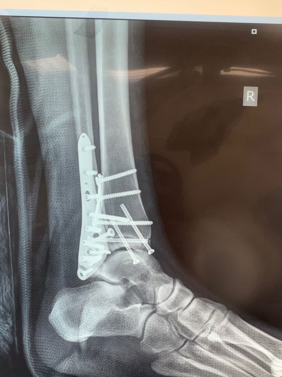 Post-operative image 2
